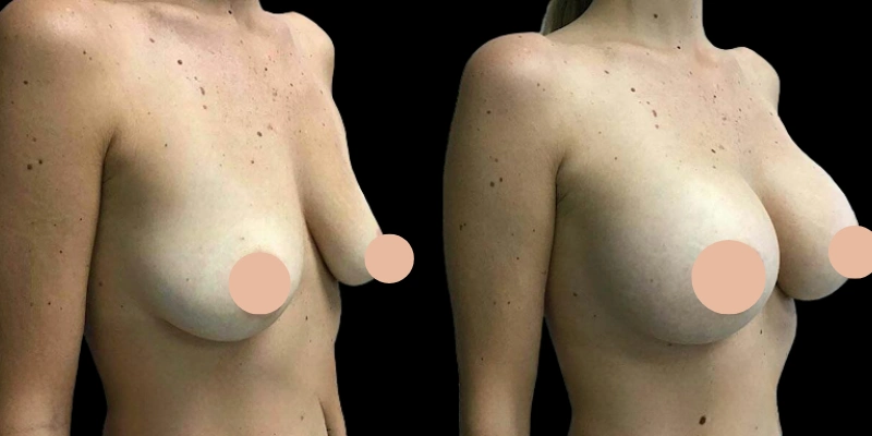 Before and after image of female breast lift